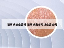 银屑病能吃酱吗 银屑病患者可以吃酱油吗