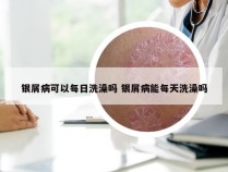 银屑病可以每日洗澡吗 银屑病能每天洗澡吗