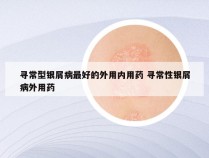 寻常型银屑病最好的外用内用药 寻常性银屑病外用药
