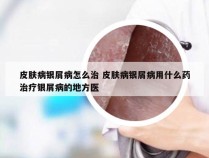 皮肤病银屑病怎么治 皮肤病银屑病用什么药治疗银屑病的地方医
