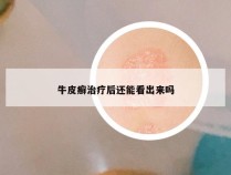 牛皮癣治疗后还能看出来吗