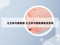 凡士林与银屑病 凡士林与银屑病有关系吗