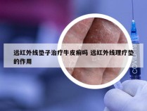 远红外线垫子治疗牛皮癣吗 远红外线理疗垫的作用