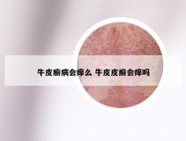 牛皮癣病会痒么 牛皮皮癣会痒吗