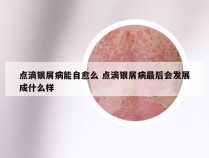 点滴银屑病能自愈么 点滴银屑病最后会发展成什么样