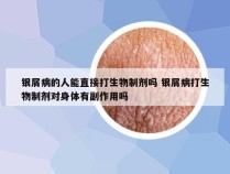 银屑病的人能直接打生物制剂吗 银屑病打生物制剂对身体有副作用吗