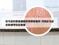 驻马店的银屑病医院有哪些医院 河南驻马店皮肤病专科在哪里