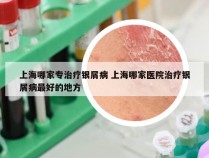 上海哪家专治疗银屑病 上海哪家医院治疗银屑病最好的地方
