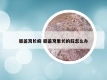 膝盖窝长癣 膝盖窝里长的藓怎么办