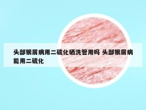 头部银屑病用二硫化硒洗管用吗 头部银屑病能用二硫化