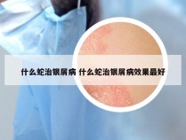 什么蛇治银屑病 什么蛇治银屑病效果最好
