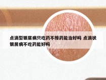 点滴型银屑病只吃药不擦药能治好吗 点滴状银屑病不吃药能好吗