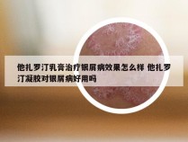 他扎罗汀乳膏治疗银屑病效果怎么样 他扎罗汀凝胶对银屑病好用吗