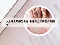 小儿身上长癣怎么办 小儿身上长癣怎么办图片