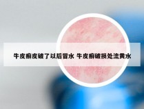 牛皮癣皮破了以后冒水 牛皮癣破损处流黄水