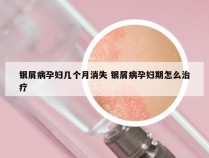 银屑病孕妇几个月消失 银屑病孕妇期怎么治疗