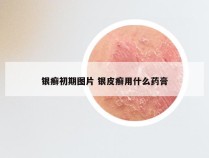 银癣初期图片 银皮癣用什么药膏