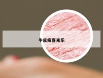 牛皮癣喜来乐