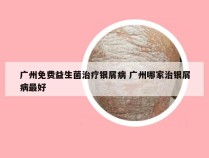 广州免费益生菌治疗银屑病 广州哪家治银屑病最好