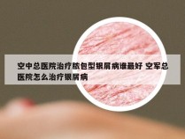 空中总医院治疗脓包型银屑病谁最好 空军总医院怎么治疗银屑病