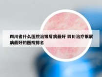 四川省什么医院治银屑病最好 四川治疗银屑病最好的医院排名