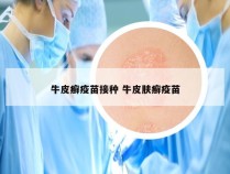 牛皮癣疫苗接种 牛皮肤癣疫苗