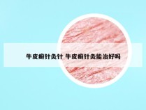 牛皮癣针灸针 牛皮癣针灸能治好吗
