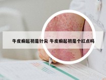 牛皮癣起初是针尖 牛皮癣起初是个红点吗