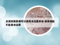 点滴状银屑病可以使用沐浴露身体 银屑病能不能用沐浴露