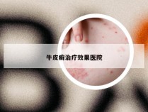 牛皮癣治疗效果医院