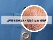 过敏性银屑病怎么才能治疗 过敏 银屑病