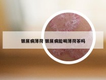 银屑病薄荷 银屑病能喝薄荷茶吗