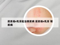 尿素维e乳膏能治银屑病 尿素维e乳膏 银屑病