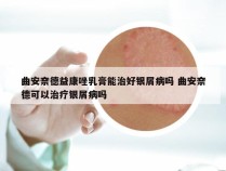 曲安奈德益康唑乳膏能治好银屑病吗 曲安奈德可以治疗银屑病吗