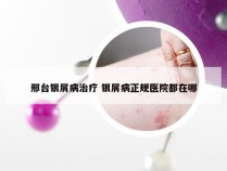 邢台银屑病治疗 银屑病正规医院都在哪