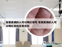 有银屑病的人可以喝红茶吗 有银屑病的人可以喝红茶吗百度百科