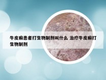 牛皮癣患者打生物制剂叫什么 治疗牛皮癣打生物制剂