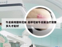 牛皮癣用醋和花椒 醋跟花椒牛皮廨治疗需要多久才能好