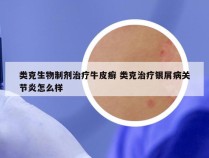 类克生物制剂治疗牛皮癣 类克治疗银屑病关节炎怎么样