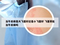 治牛皮癣是大飞蓬好还是小飞蓬好 飞蓬草能治牛皮癣吗