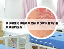 长沙哪里可以确诊牛皮癣 长沙有没有专门看皮肤病的医院