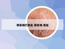 银屑病打美能 银屑病 美能