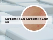头皮银屑病不长头发 头皮银屑病不长头发怎么办