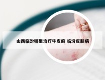 山西临汾哪里治疗牛皮癣 临汾皮肤病