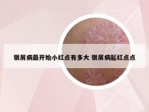 银屑病最开始小红点有多大 银屑病起红点点