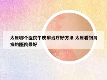 太原哪个医院牛皮癣治疗好方法 太原看银屑病的医院最好