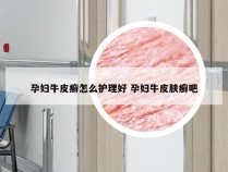 孕妇牛皮癣怎么护理好 孕妇牛皮肤癣吧