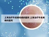上海治疗牛皮癣权威的医院 上海治疗牛皮病癣的医院
