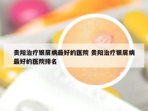 贵阳治疗银屑病最好的医院 贵阳治疗银屑病最好的医院排名