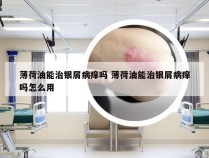 薄荷油能治银屑病痒吗 薄荷油能治银屑病痒吗怎么用